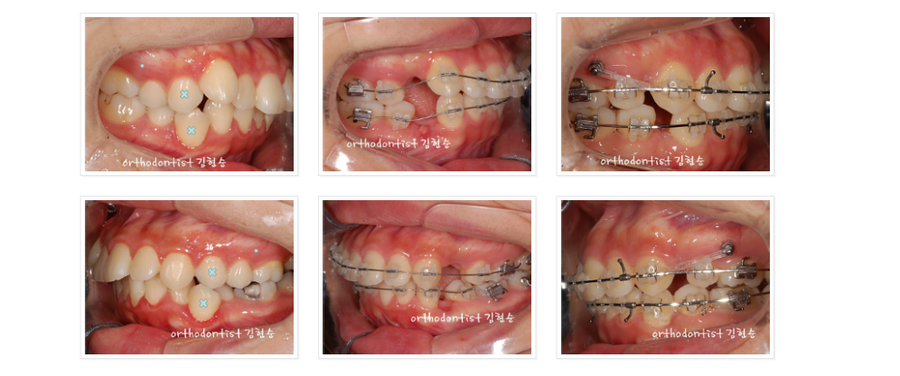 돌출입 발치교정, 미니스크류를 통한 6가지 변화 관련 이미지 9
