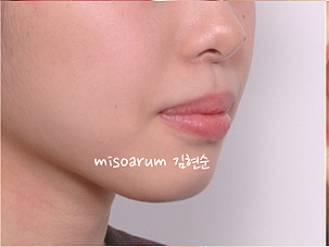 강남 돌출입 교정 관련 이미지 9