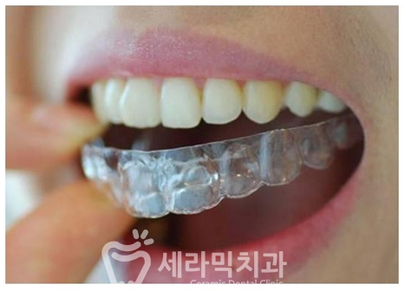 치아교정 유지장치와 틀니, 제대로 관리하는 법! 관련 이미지 2