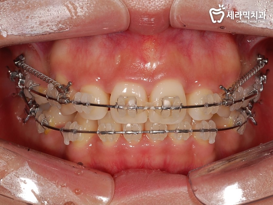 돌출입 교정으로 외모변화를 확인 관련 이미지 2