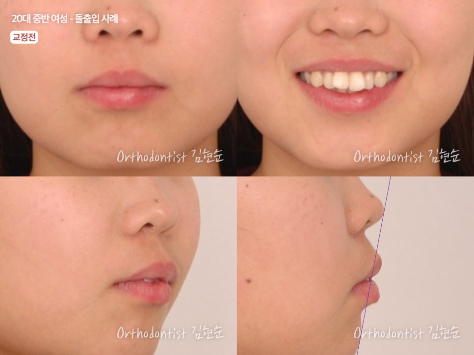 학동역치과 치아교정은 여기서 !! 관련 이미지 17