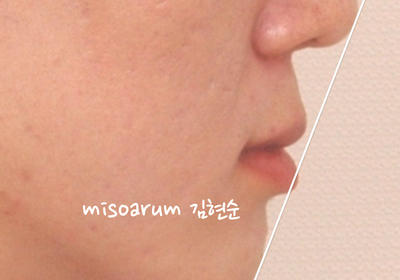 반대교합 관련 이미지 25