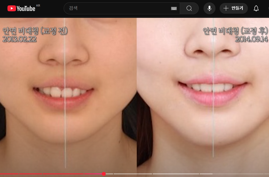 앞니 중심선 안맞으면, 안면비대칭인가요? [치아교정 필요한 예시] 관련 이미지 5