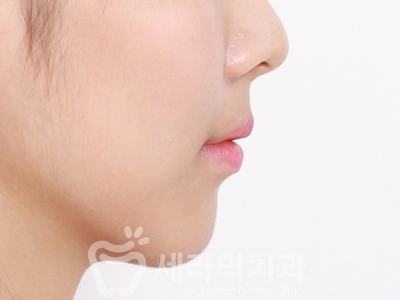 과개교합 치아교정잘하는곳, 세라믹치과 치아교정전후! 관련 이미지 27