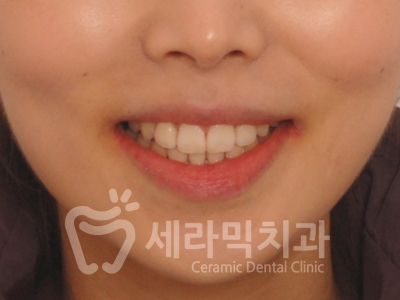 돌출입 덧니 비대칭 치아교정 전후 인상변화! 관련 이미지 1