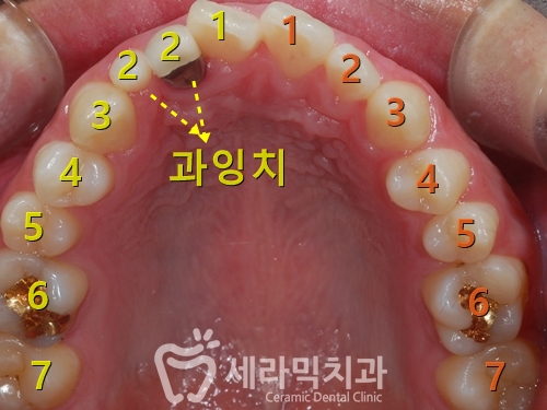돌출입 투명교정 치아교정전후 관련 이미지 3