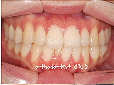 강남 돌출입 교정 관련 이미지 11