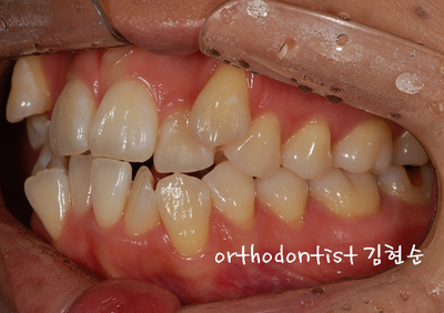 강남 덧니 관련 이미지 10
