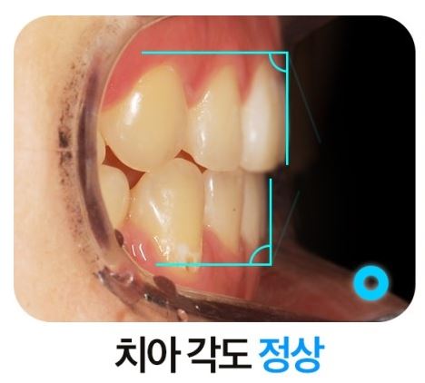 발치교정 부작용 옥니 해결법 관련 이미지 5
