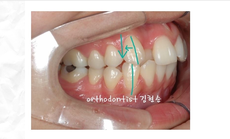 돌출입교정 / 기간 / 비용 관련 이미지 3
