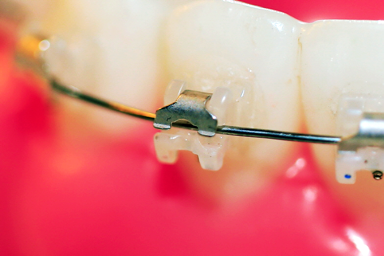 클리피씨 교정 월17만에 ~ 관련 이미지 4