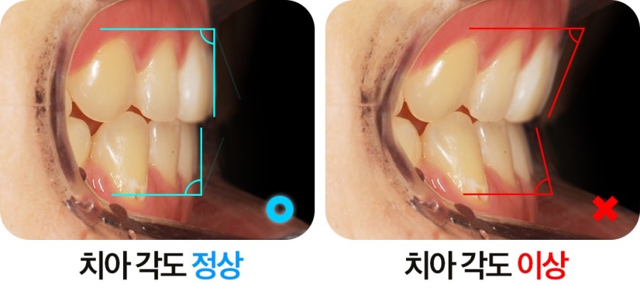 치아각도 교정과정 관련 이미지 4