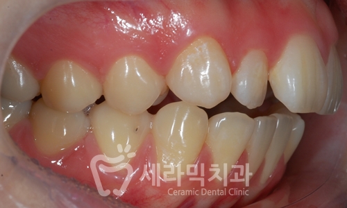 앞니 돌출, 개방교합으로 치아교정을 시작했는데, 작았던 아래턱이 커졌어요! 관련 이미지 7