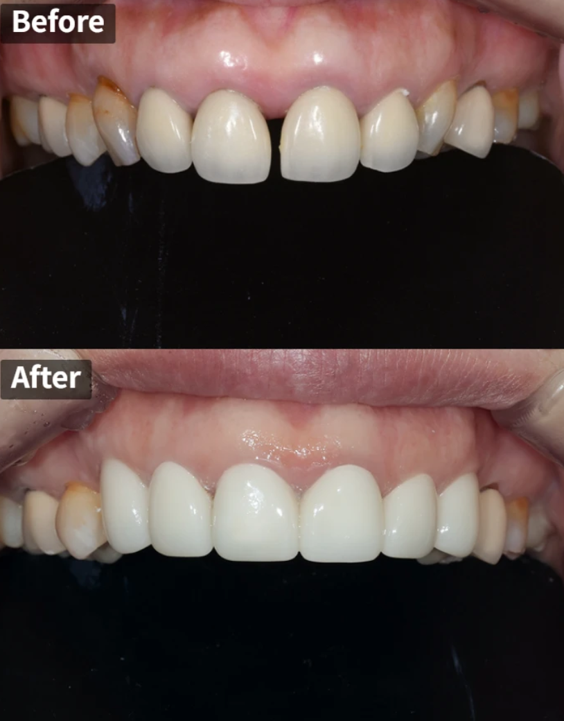 일본에서 거절당했던 앞니 심미보철 크라운 관련 이미지 1