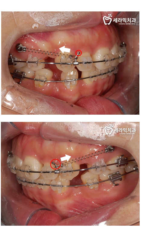 학동역 돌출입교정 세라믹치과 관련 이미지 6