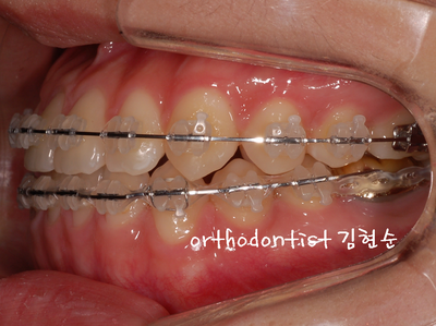 반대 교합 관련 이미지 22