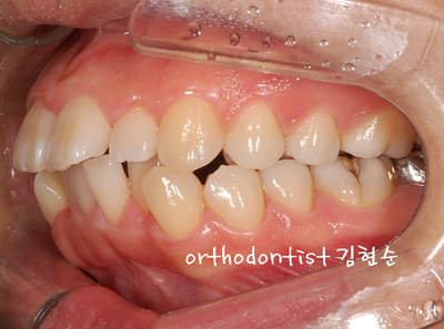 강남 돌출 관련 이미지 9