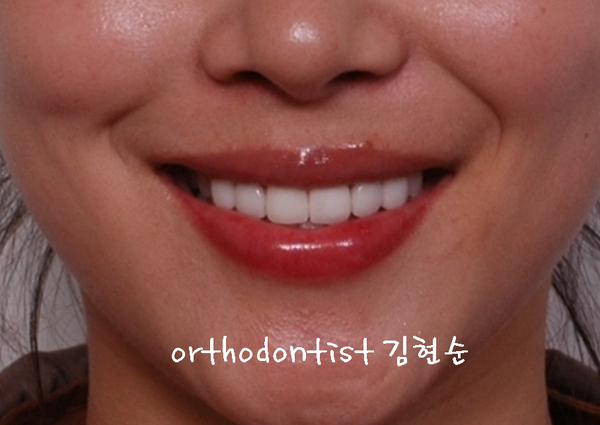 강남 덧니, 돌출 관련 이미지 30