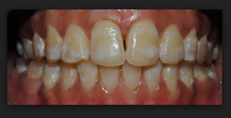 치아교정 부작용 탈회와 치아우식 관련 이미지 3