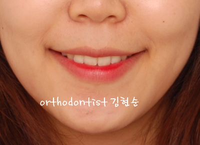 강남 돌출 관련 이미지 28