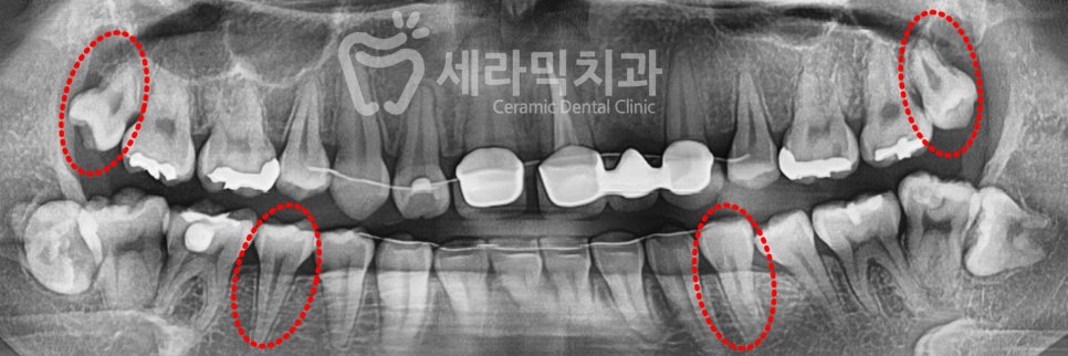 돌출입 치아벌어짐 치아재교정 전후. 세라믹치과 관련 이미지 6
