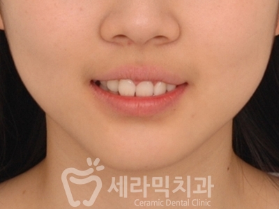 과개교합 치아교정잘하는곳, 세라믹치과 치아교정전후! 관련 이미지 5
