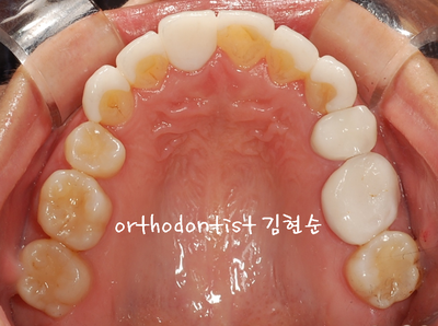 강남 덧니, 돌출 관련 이미지 26