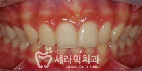 과개교합, 딥바이트 비발치 치아교정전후 관련 이미지 2