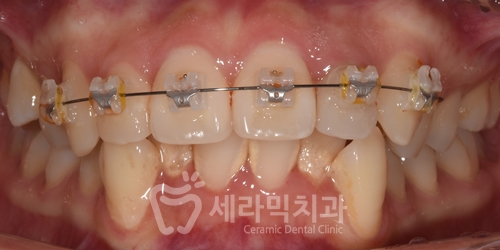Before and After Orthodontic Treatment for Protruding Mouth and Deep Bite: A Calmer, More Sophisticated Transformation! image 9
