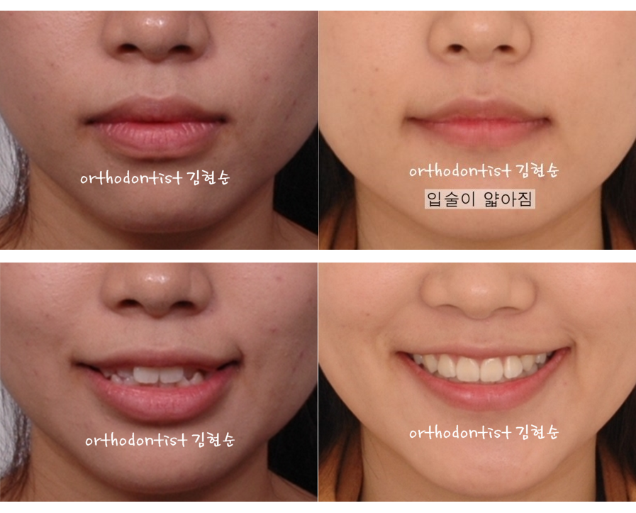 세라믹교정 세라믹치과-돌출입발치교정 4 관련 이미지 6