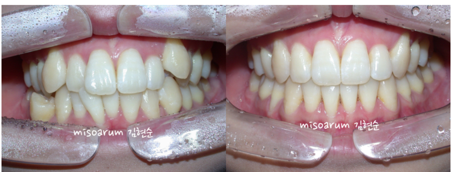 세라믹교정 덧니교정 관련 이미지 6