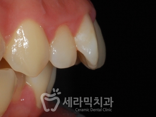 치아교정만으로 세마리 토끼를 한번에! 돌출입, 무턱, 치열불규칙 치아교정전후 관련 이미지 1