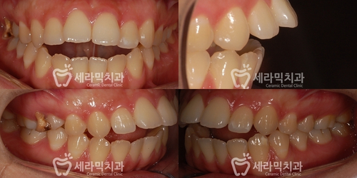 치아교정전후 영상. 돌출입과 개방교합 치아교정 전후 관련 이미지 1