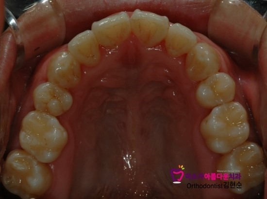학동역치아교정잘하는치과 미소가아름다운치과 덧니교정 과정 관련 이미지 5