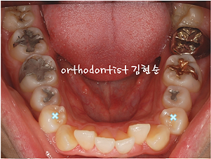 강남 돌출입 교정 관련 이미지 21