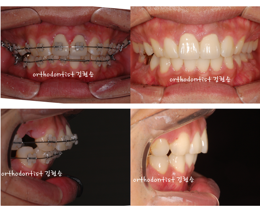 세라믹교정 세라믹치과-돌출입발치교정 1 관련 이미지 4