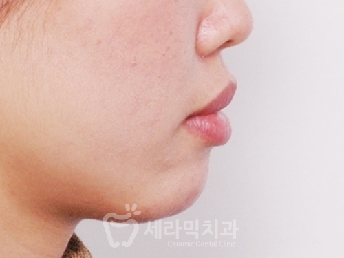 돌출입교정만 했을 뿐인데, 성형한 것처럼 달라진 인상! 관련 이미지 6
