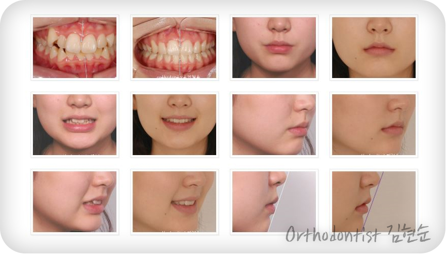 돌출입 비발치 치아교정 관련 이미지 8