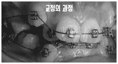 클리피씨교정 기간 짧을까? 관련 이미지 3