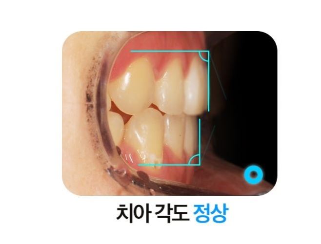 돌출입교정 옥니 부작용 방지 교정브라켓 관련 이미지 5
