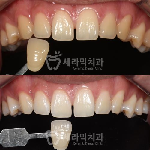 연말 치아미백 이벤트 , 학동역 세라믹치과 관련 이미지 8