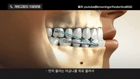 개방교합이란? 앞니와 어금니 상태에 따라 달라지는 교정 방향 관련 이미지 4