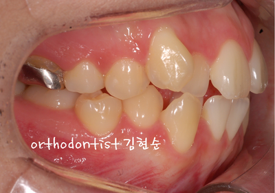 치열 교정(치열 불규칙) 관련 이미지 9