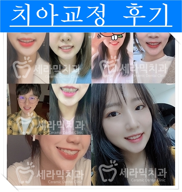 앞니돌출과 과개교합 치아교정전후, 세련된 이미지로 변신! 관련 이미지 2