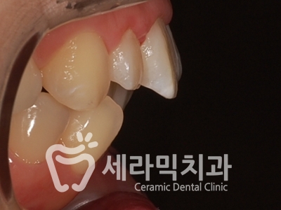 돌출입 잇몸노출 치아교정 전후 인상변화 사례 관련 이미지 9