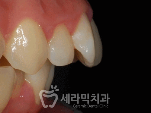 치아교정만으로 세마리 토끼를 한번에! 돌출입, 무턱, 치열불규칙 치아교정전후 관련 이미지 11