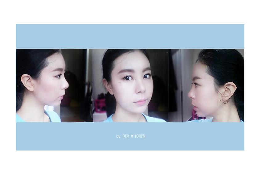 세라믹치과 치아교정일기 - 김여정 관련 이미지 4