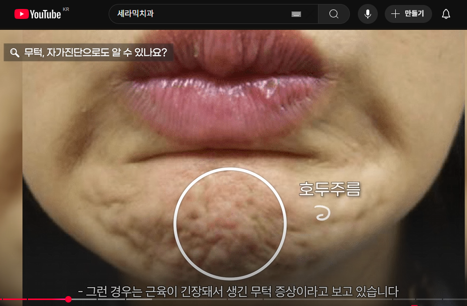 수술없이 얼굴 턱선 정리하는 치아교정, 무턱교정 관련 이미지 3