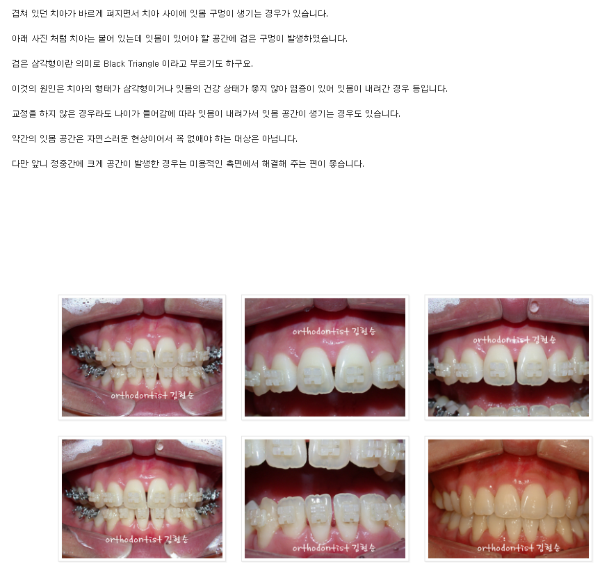 앞니가 돌출된 경우, 발치 교정 후 블랙 트라이앵글(치아 사이 공간) 삭제 관련 이미지 4