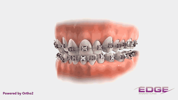 과개교합 무턱 개선 관련 이미지 6